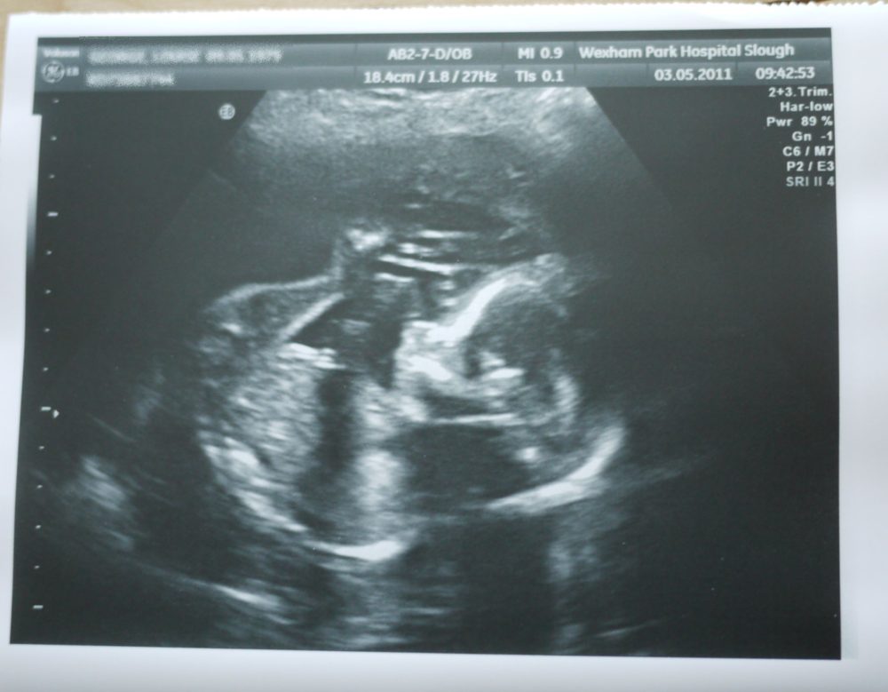 An ultrasound image of Jessica at the 20 week scan