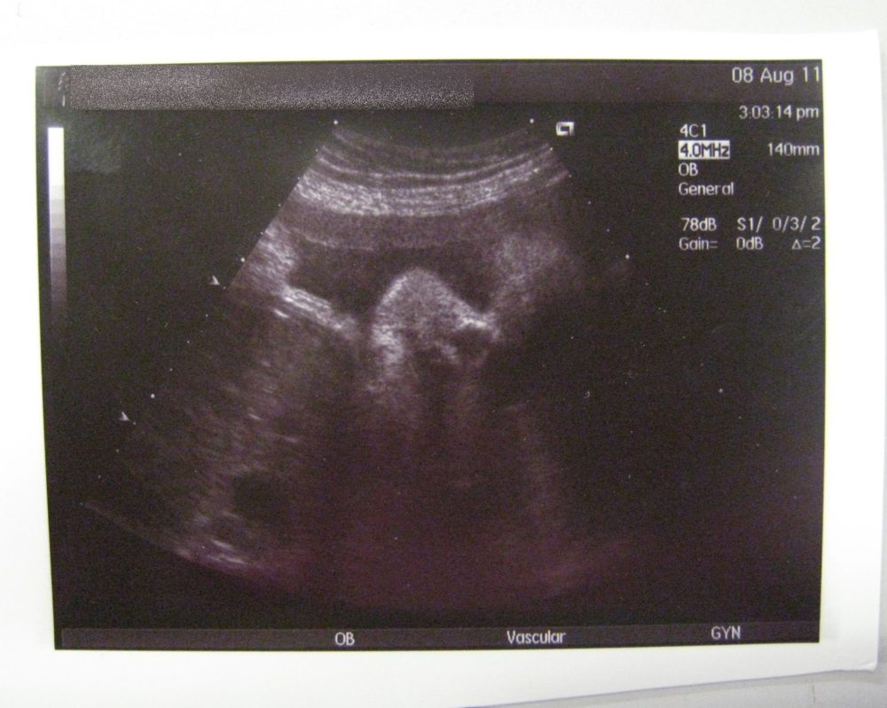 An ultrasound image of Jessica at 34 weeks' gestation