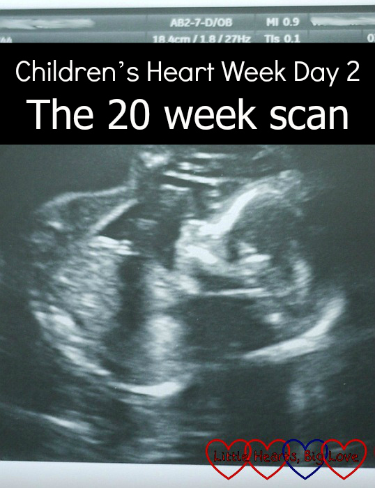 A scan photo of Jessica at 20 weeks' - "Children's Heart Week Day 2: The 20 week scan"