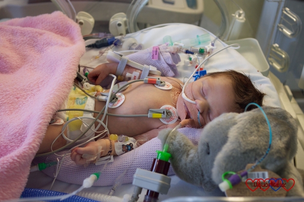Jessica on PICU just before her first open heart surgery