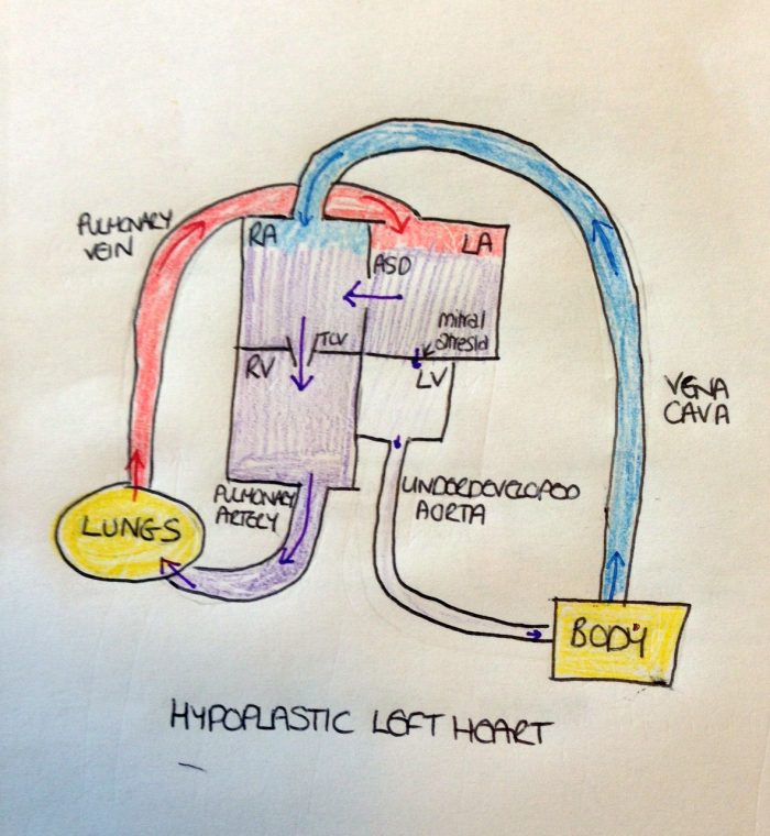 A diagram showing the circulation with hypoplastic left heart
