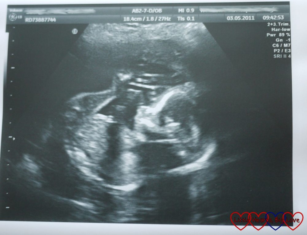 An ultrasound image of Jessica on the 20 week scan