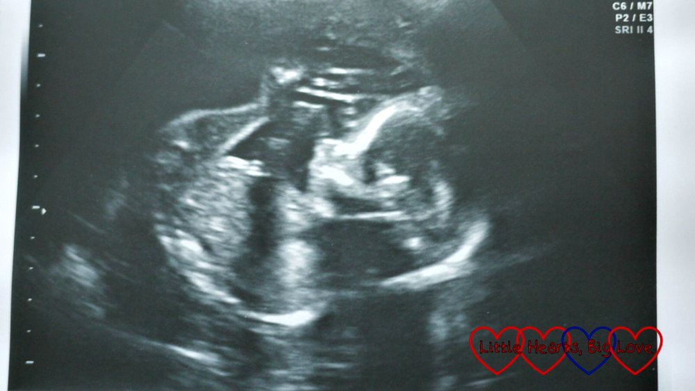Jessica at the 20 week scan