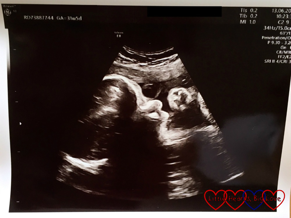 Scan photo of Peanut at 32 weeks